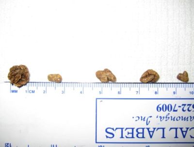 Bladder stones